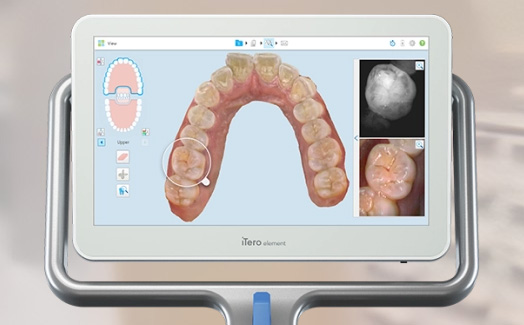 iTero digital scanner