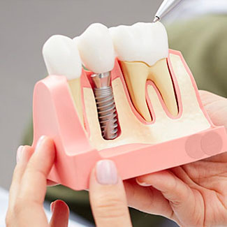 Model of dental implant